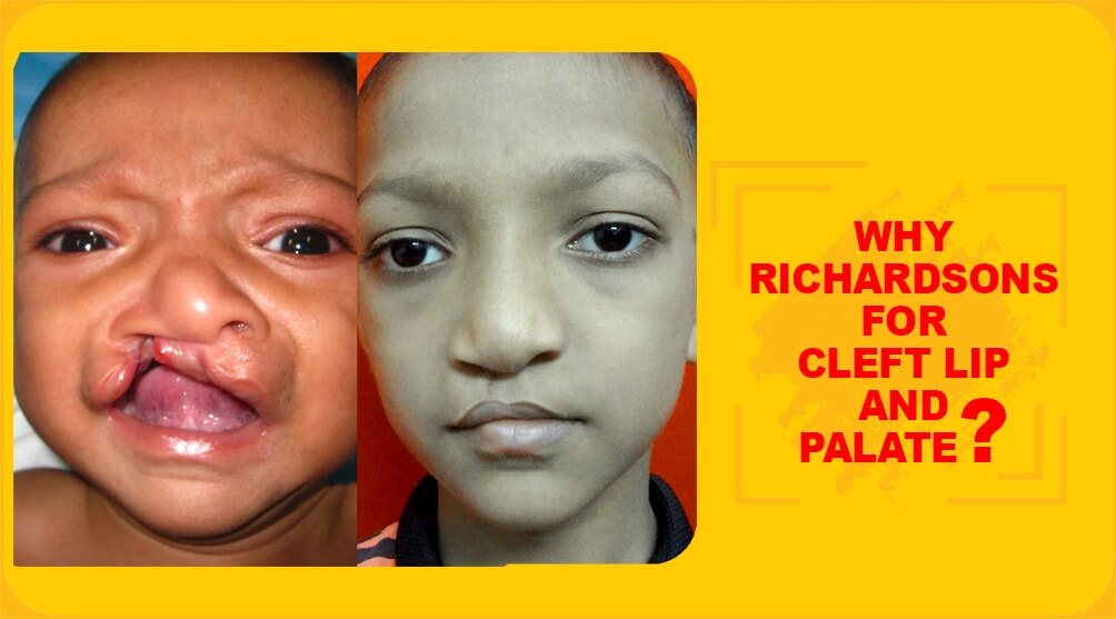 Why Richardsons for cleft lip and palate