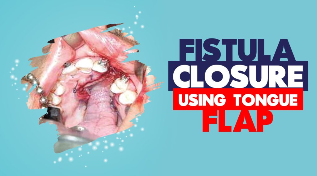 Fistula Closure Treatment in India