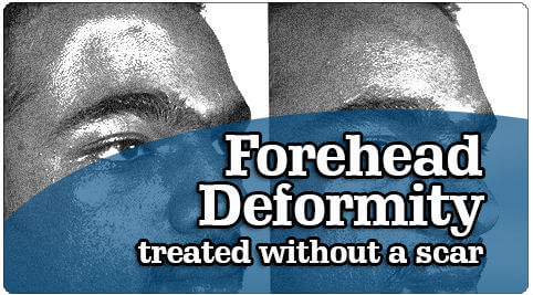 Forehead Deformity Treatment in India