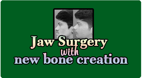 Jaw Surgery with new bone creation
