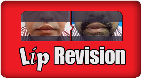 Lip revision surgery in Nagercoil