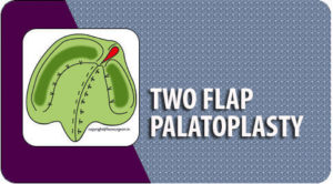 Two flap palatoplasty Surgery in Tamil Nadu