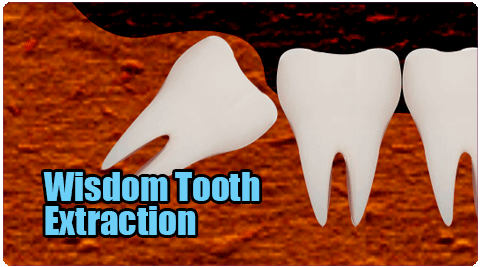 Wisdom Tooth Extraction in Tamil Nadu