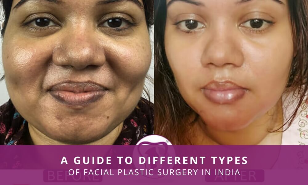Different types of facial plastic surgery
