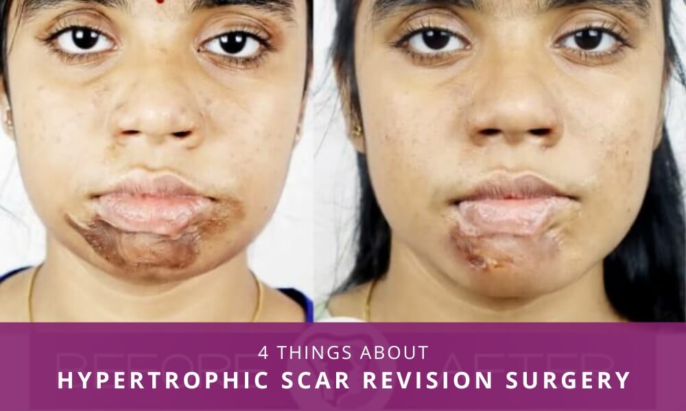 Hypertrophic Scar Revision Surgery